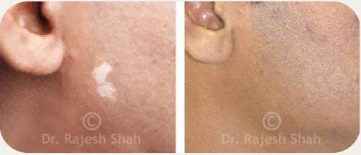 Vitiligo before and after homeopathic treatment