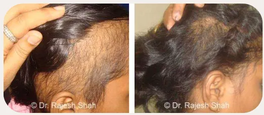 Alopecia before and after homeopathic treatment