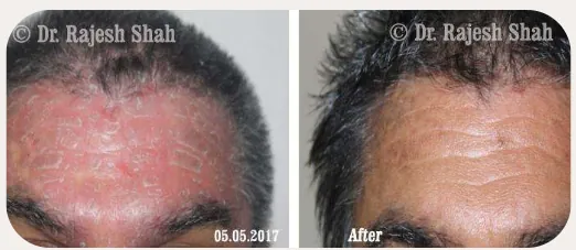 Psoriasis before and after homeopathic treatment