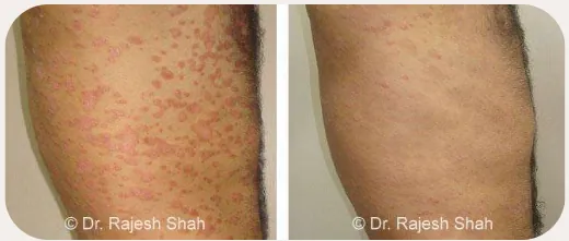 Urticaria before and after homeopathic treatment