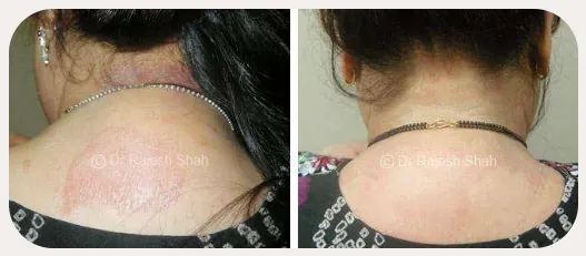 Lichen Planus before and after homeopathic treatment
